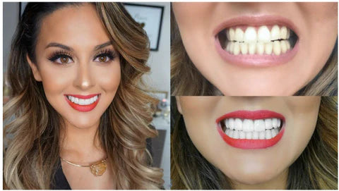Snap On Smile