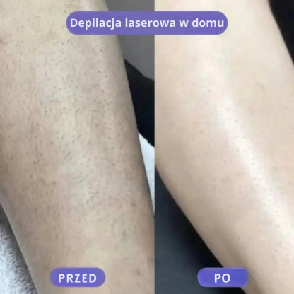 LisseLáser™ – Powiedz żegnaj niechcianym włoskom 🌸