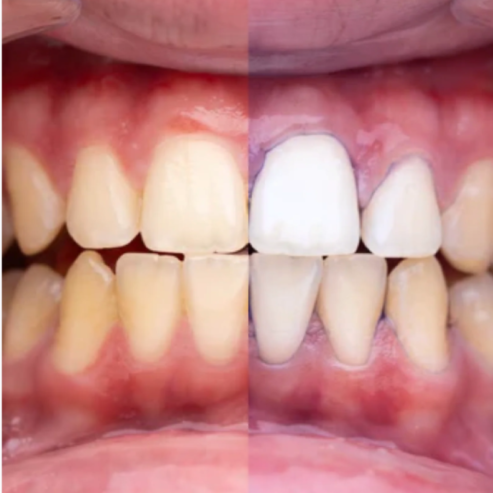 GlumiWhite™ – V34 Fehérítő – [AKCIÓ CSAK MA ÉRVÉNYES]